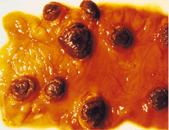 사진16) 돼지열병에 감염된 돼지 맹장의 단추양궤양(button ulcer) 이미지