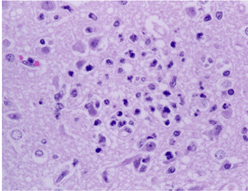 사진19) 돼지열병에 감염된 돼지 대뇌의 신경교증(gliosis) 이미지