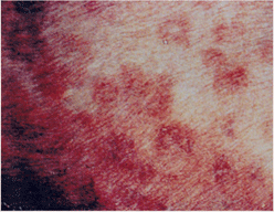 사진52) 돼지 단독에 감염된 돼지. 피부에 갈색의 반점. 이미지