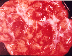 사진10) 사진 9의 확대 사진. 림프절의 피막하와 림프여포 주위에 심한 출혈이 관찰됨 이미지